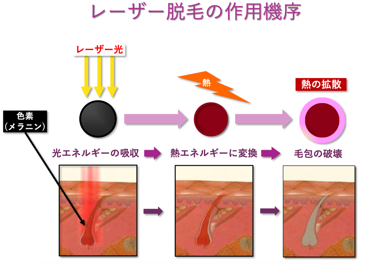 【画像】レーザー脱毛の作用機序